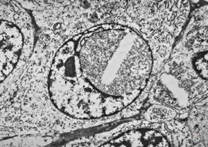 M,62y. | plasmocytoma - nasal cavity